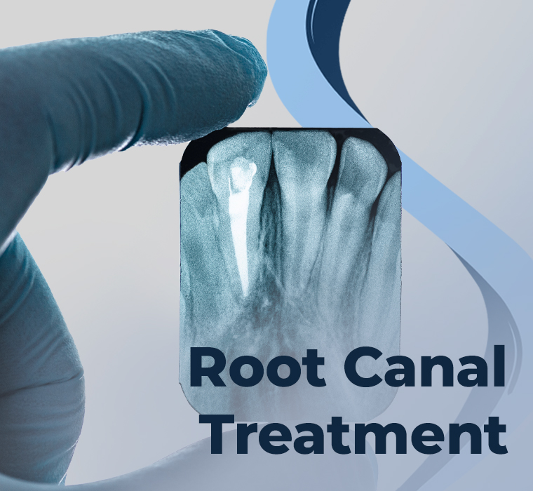 Root Canal Treatment